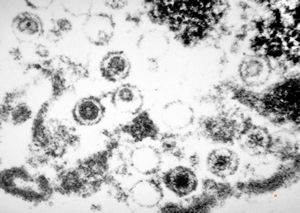 F,65y. | Epstein-Barr or cytomegaly virus - hairy leukoplakia - tongue F,65y. | Epstein-Barr or cytomegaly virus - hairy leukoplakia - tongue